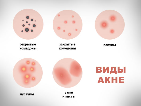 Внешний вид разных видов акне